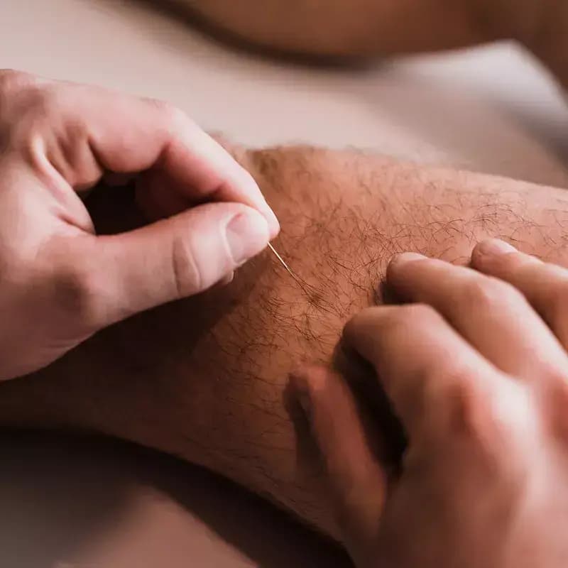 Dry Needling in onze fysiopraktijk